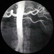 Angiography of the abdominal aorta and branches