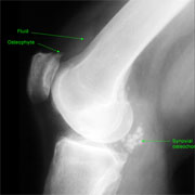 Plain x-ray of osteoarthritic knee