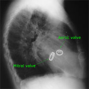 Lateral chest x-ray showing mechanical valves