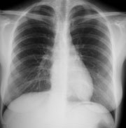 Plain chest x-ray