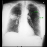 Cavitating chest lesions