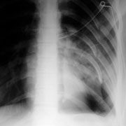 Chest x-ray showing fractured ribs and pneumothorax