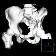 3D reconstruction of the pelvis based on CT