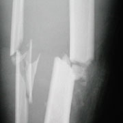 Comminuted fracture of tibia and fibula