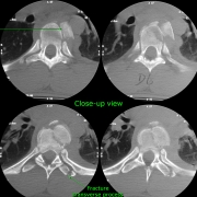 Thoracic vertebral fracture