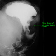 Contrast x-ray of stomach with polypoidal lesion