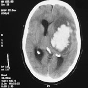 CT of hypertensive haemorrhage with mass effect