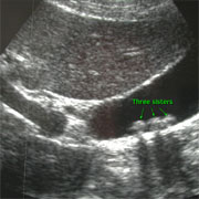 Ultrasound of the gallbladder showing gallstones