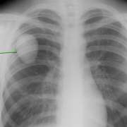 Lesion seen on chest x-ray