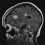 Enhancing lesions in brain MR