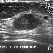Fibroadenoma of the breast on ultrasound