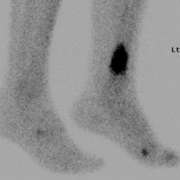 Nuclear medicine scan showing hot spot in ankle