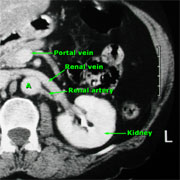 Contrast CT of a normally enhancing kidney