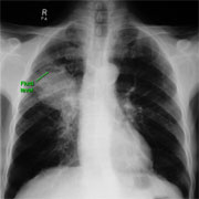 X-ray of thin-walled cavitating carcinoma