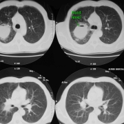 CT of fluid level in cavitating carcinoma