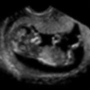 Foetal ultrasound